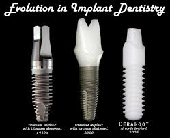 Evolucion implantes y estetica